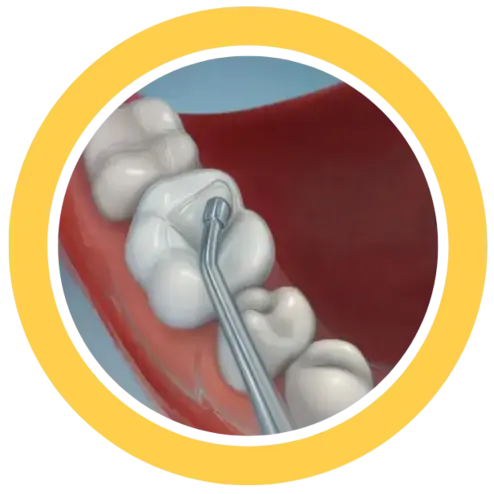 Cosmetic Teeth Filling