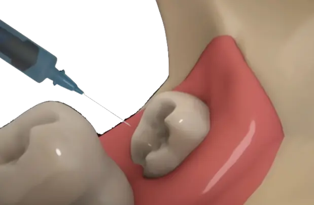 Local Anesthesia Local Anesthesia