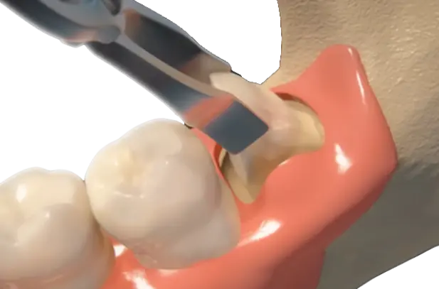 Tooth Extraction Tooth Extraction