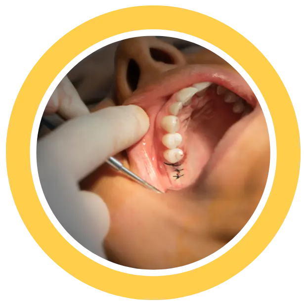 Minor Oral Surgery