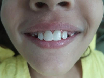 Traumatic, Chipped Tooth After Treatment