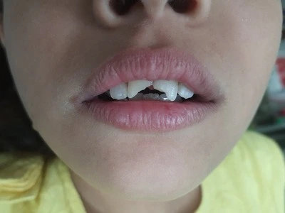 Traumatic, Chipped Tooth Before Treatment