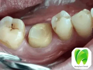 Processing For Dental Cap