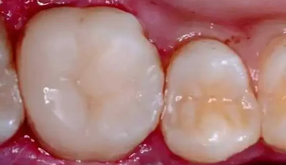 cosmetic teeth filling after