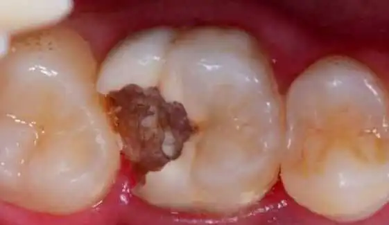 cosmetic teeth filling before