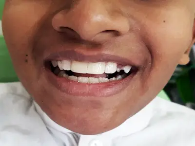 Traumatic, Chipped Tooth After Treatment