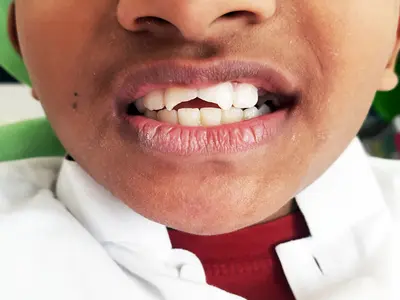 Traumatic, Chipped Tooth Before Treatment