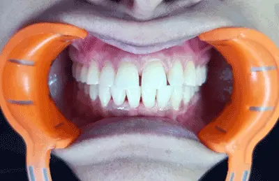 After Scaling and Polishing