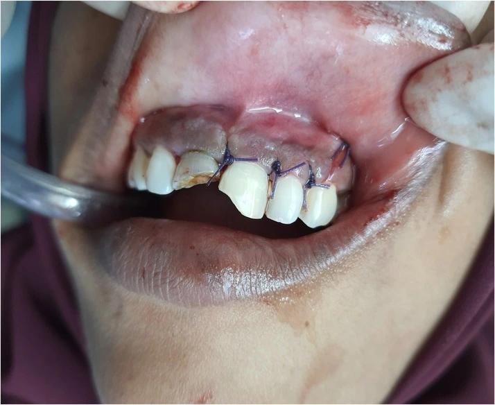 Under Minor Oral Surgery
