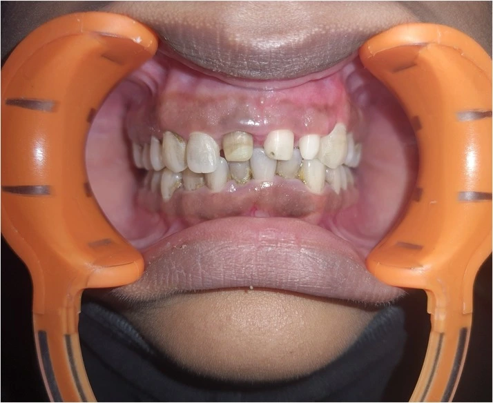 Healing After Minor Oral Surgery