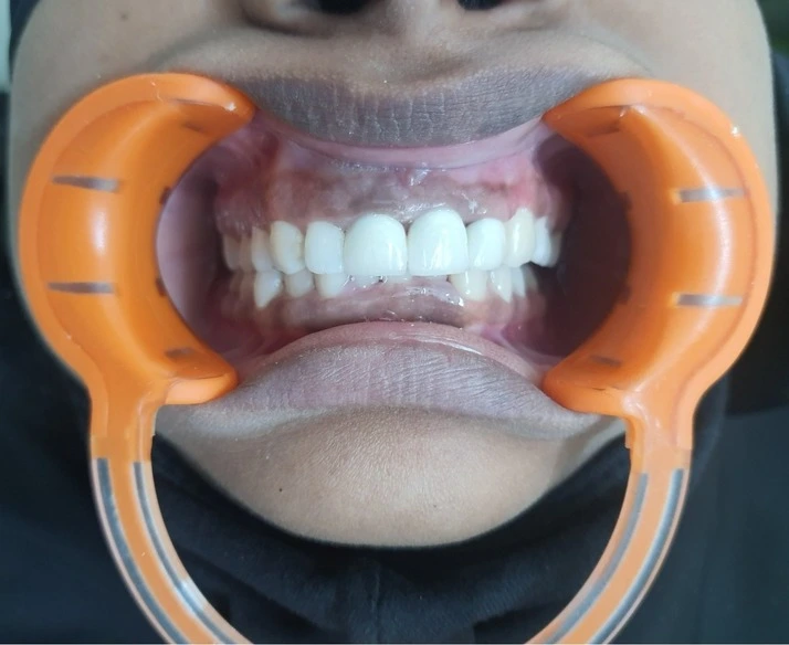 After Minor Oral Surgery