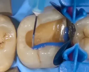 Step 1: Cosmetic Filling