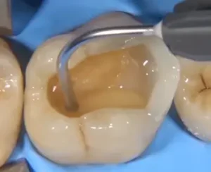 Step 2: Cosmetic Filling