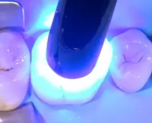 Step 3: Cosmetic Filling