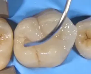 Step 1: Cosmetic Filling